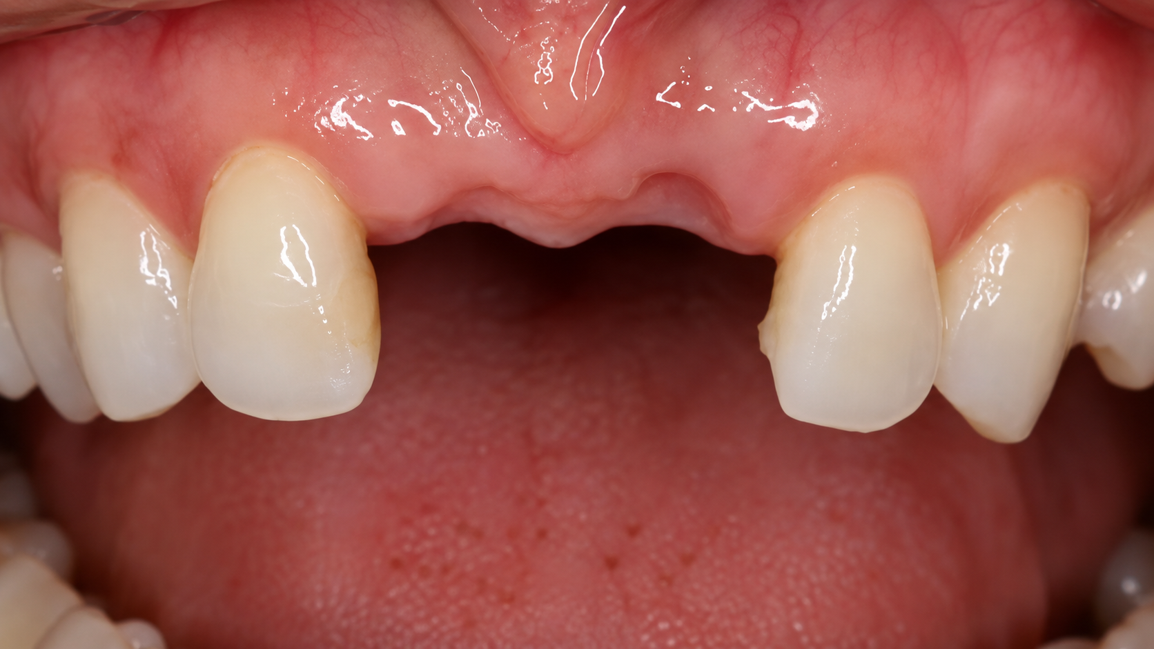 After Treatment